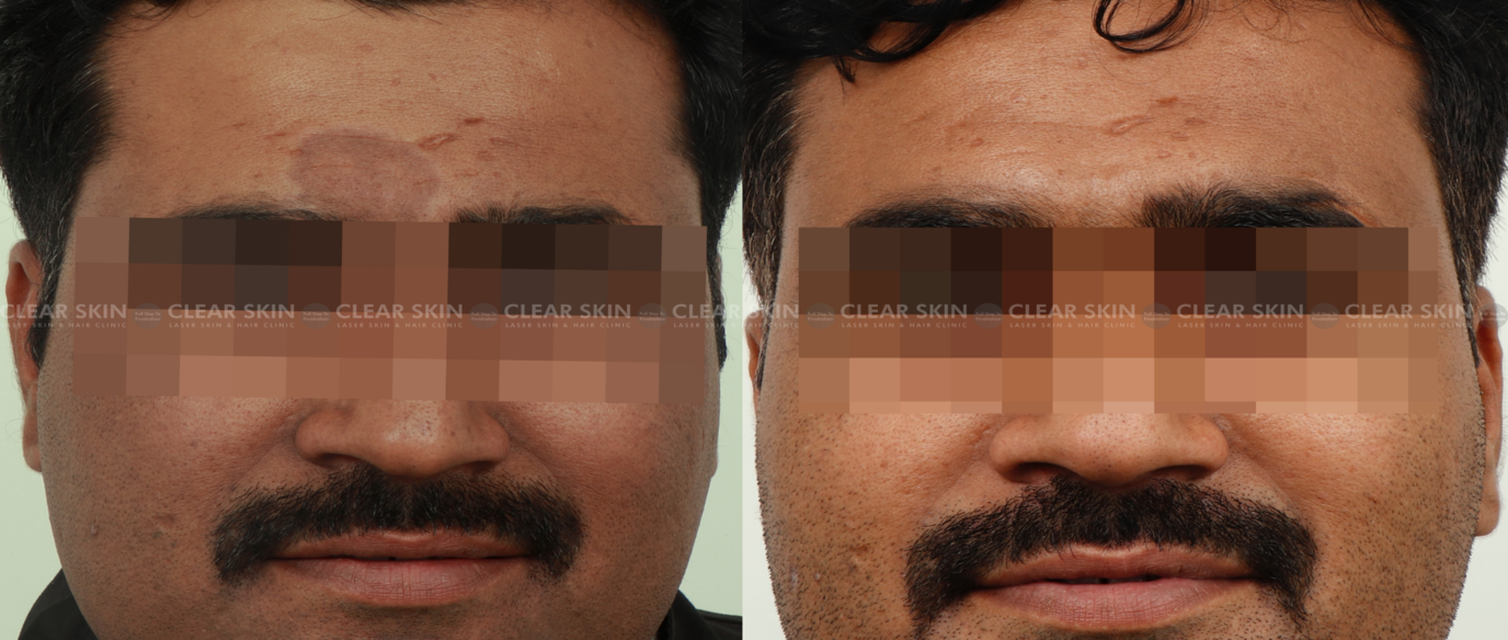 Laser Pigmentation Removal Before And After