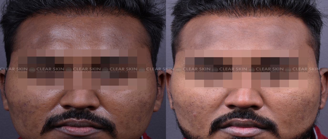 Pigmentation Treatment Before And After