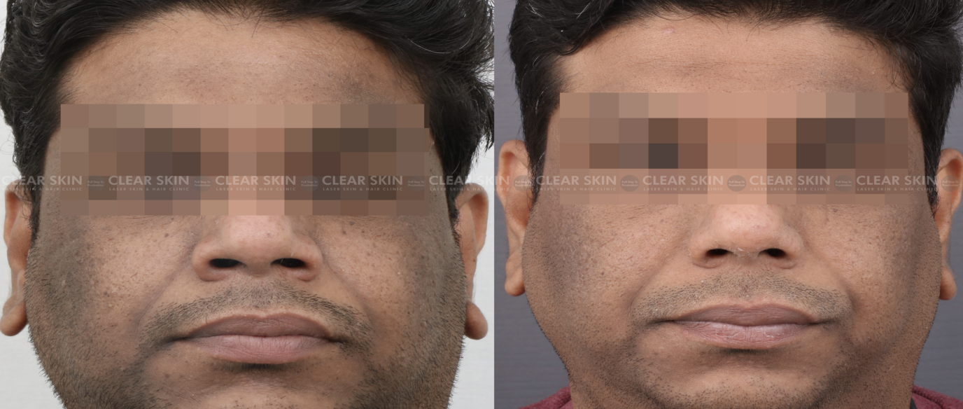 Pigmentation Before And After