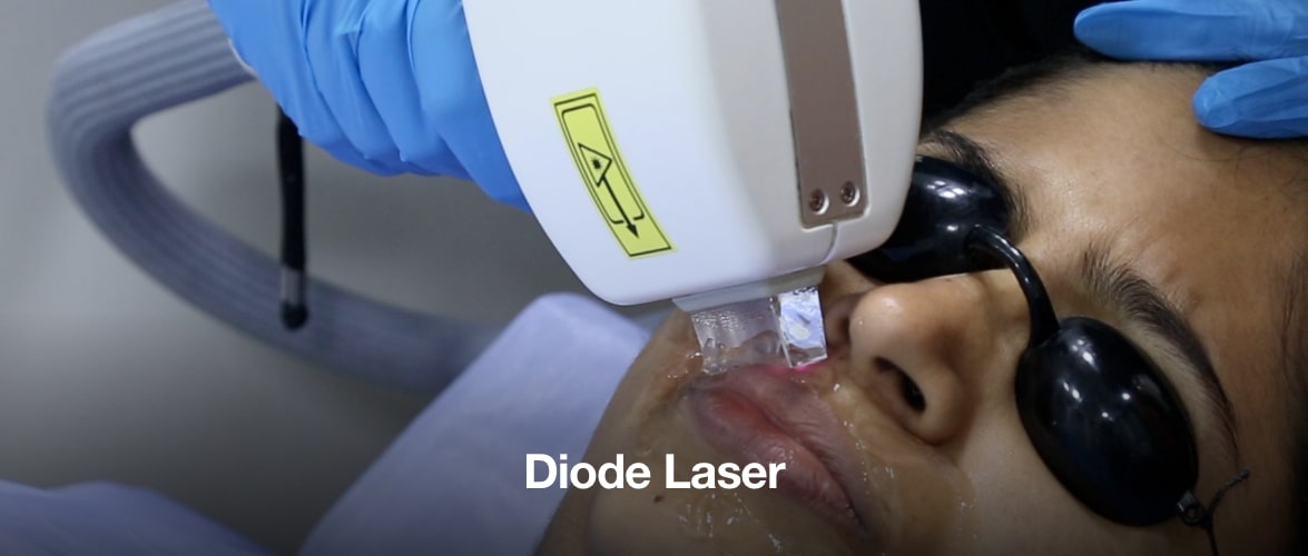 Diode Laser Hair Removal - Benefits and Treatment Cost | Clear Skin, Pune