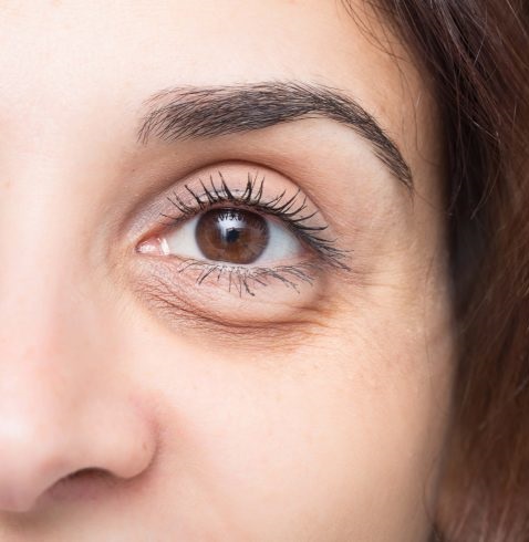 Under Eye Bags: Causes, Symptoms, Home Remedies and Treatment