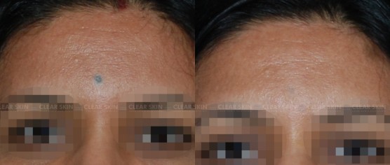 Face Tattoo Removal Before And After