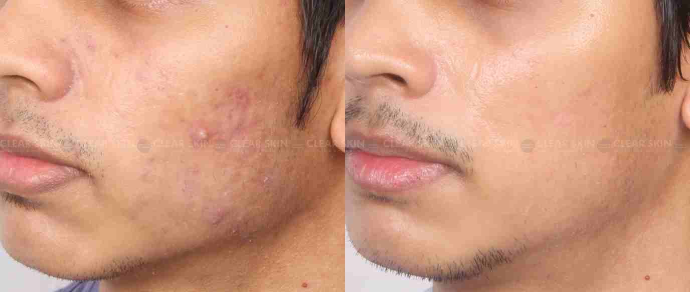 Pimple Treatment Before And After Photo