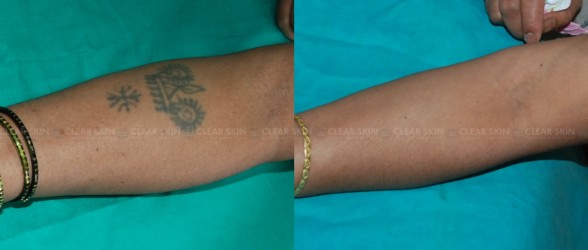 Hand Tattoo Removal Before And After
