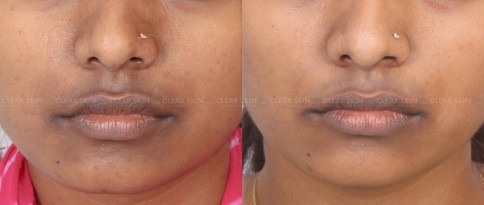 Pigmentation Around Mouth Before And After