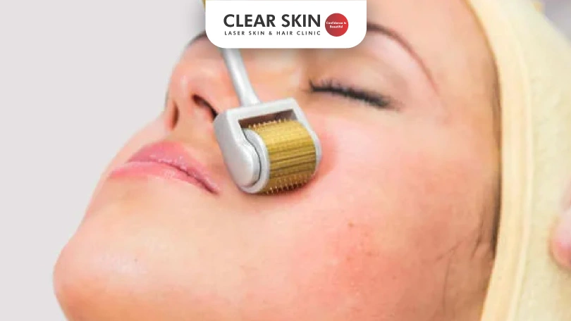 Dermaroller for Acne Scars Are They Safe and Really Work?