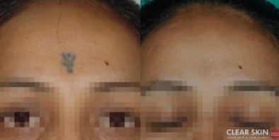 Tattoo Removal Results - Before and After Pictures