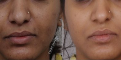 Skin Pigmentation Treatment - Before and After Images