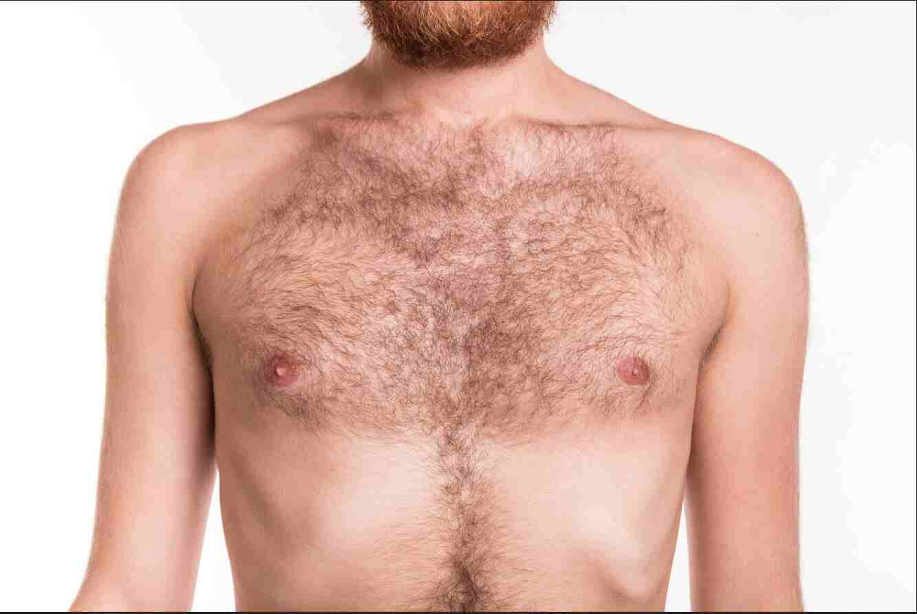 Excessive Body Hair - Laser Hair Removal