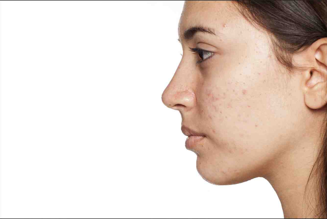 Acne/Pimples