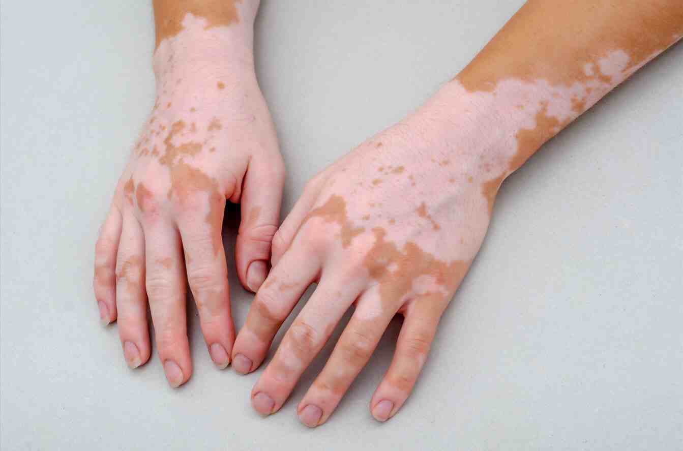 Vitiligo On Hand
