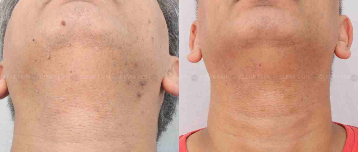Warts Removal Face Before And After Pictures