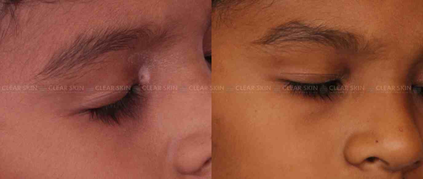 Vitiligo On Eye Before And After