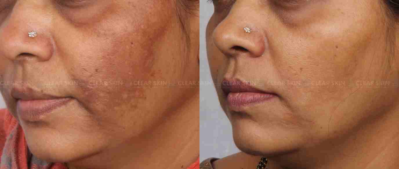 Laser Treatment For Melasma Before And After
