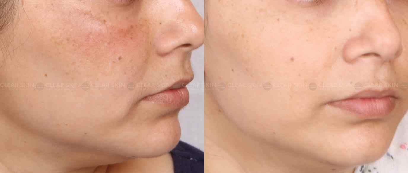Chemical Peel For Melasma Before And After