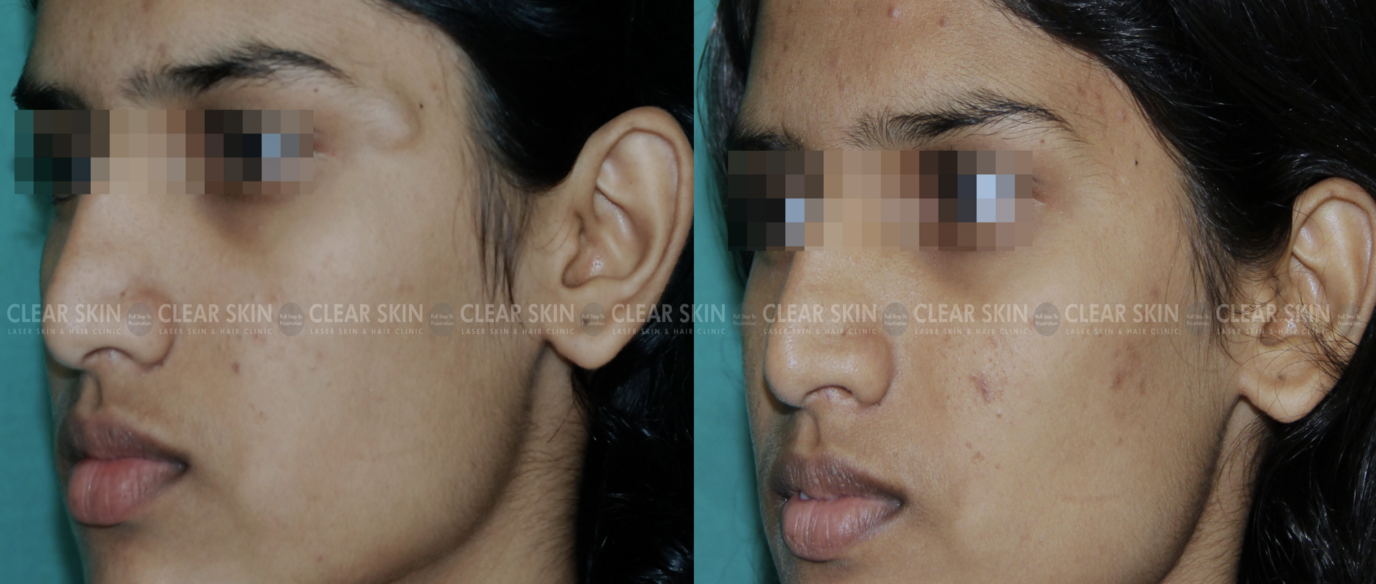 Cyst_BeforeAfter4