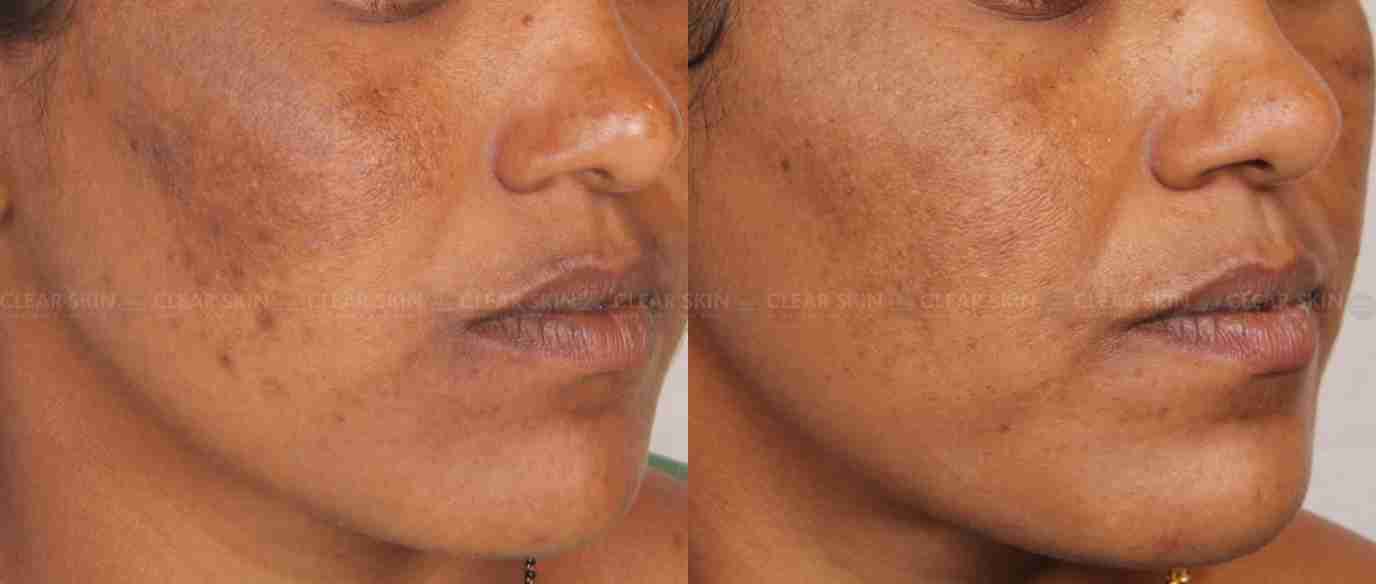 Melasma Treatment Before And After