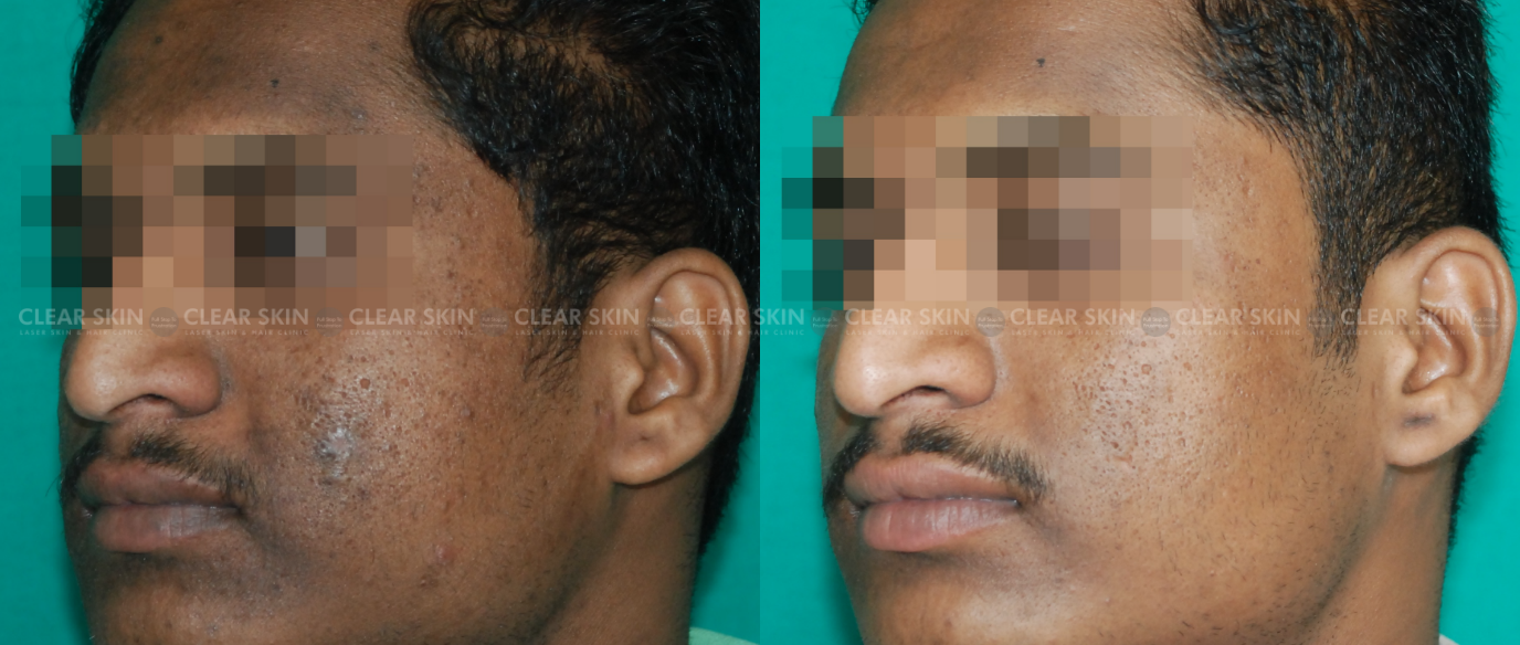 Clear Skin  Laser Skin  Hair Clinic MultiSpeciality Clinic in Pimple  Saudagar Pune  Book Appointment View Fees Feedbacks  Practo
