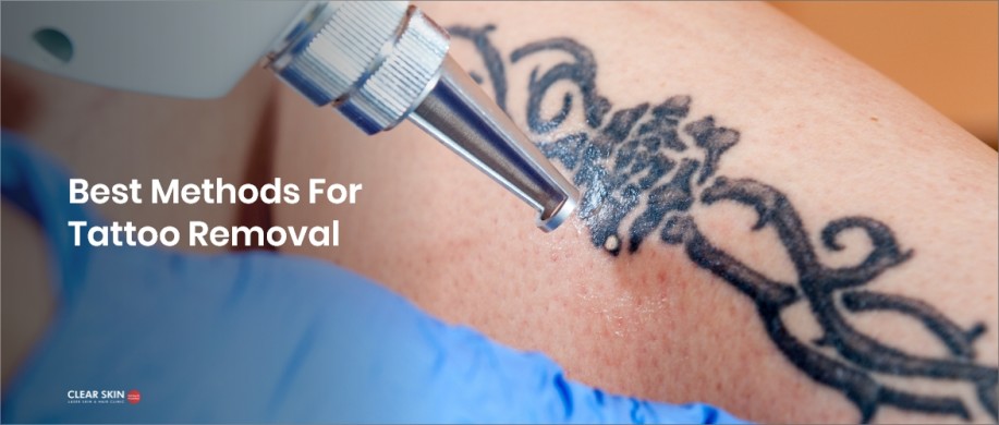 Best Tattoo Removal Method: Expert Dermatologist, ClearSkin