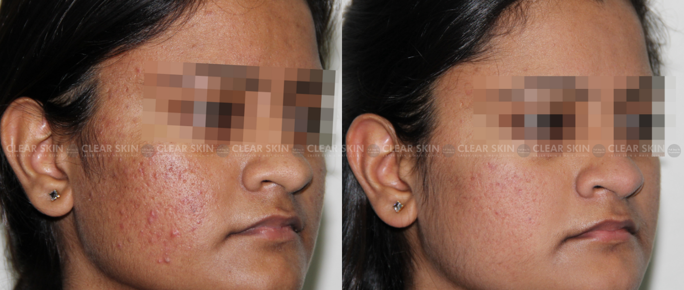 Dermapen Microneedling | Get Flawless Skin | Clear Skin Pune