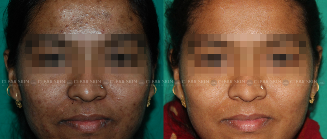 ClearSkin  terapie laser pentru acnee  SKINMED Clinic