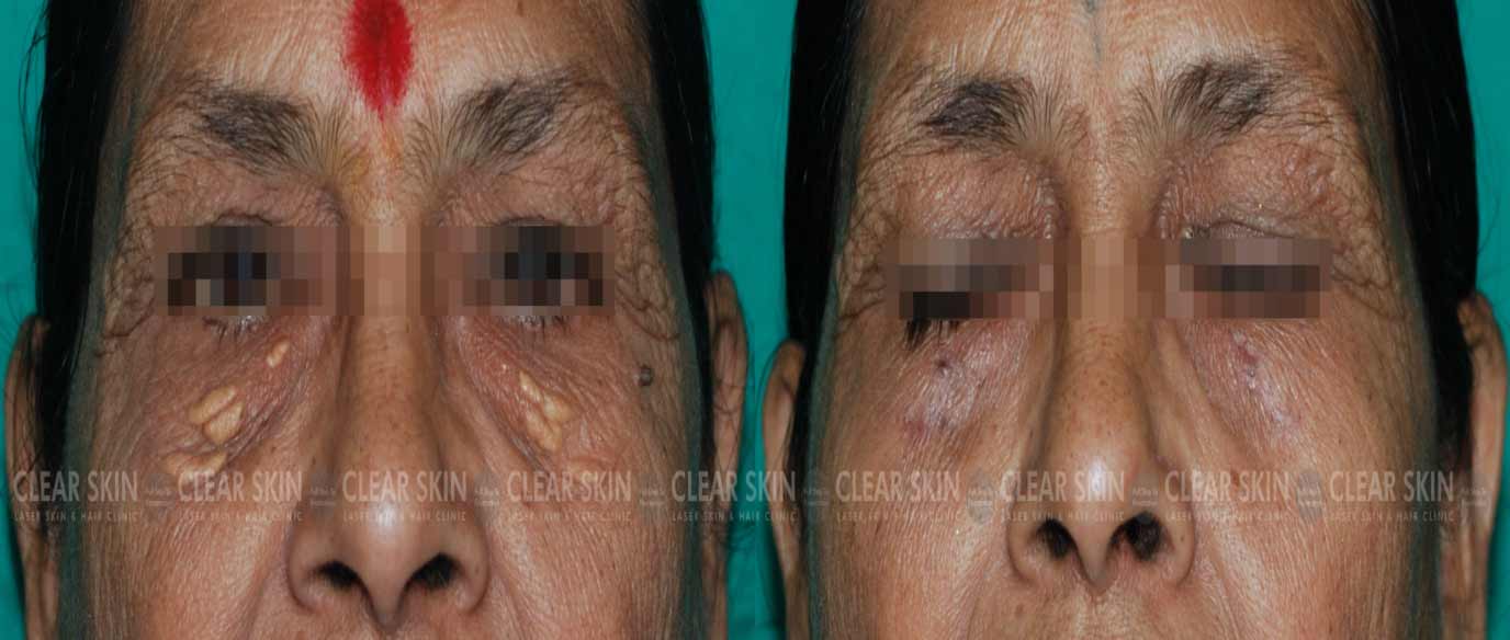Eye Xanthelasma Removal Pictures Before And After