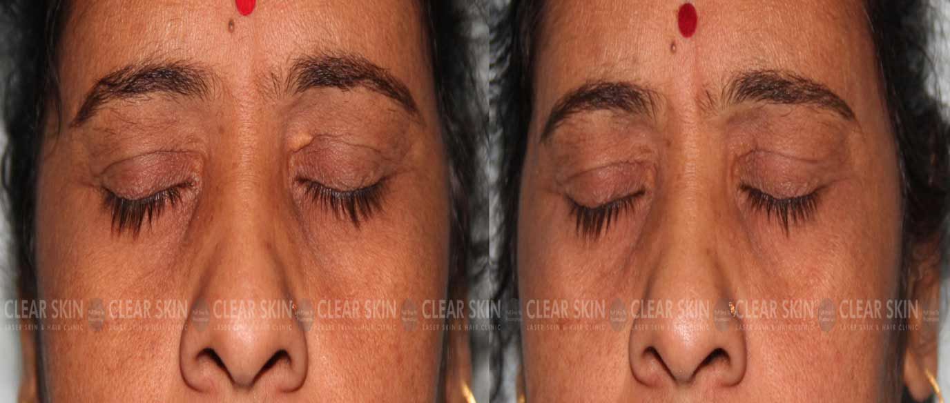 Eye Xanthelasma Removal Results Before And After