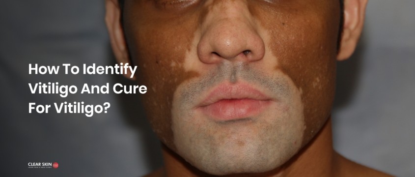 Vitiligo: Types, Symptoms, Causes & Treatment | ClearSkin