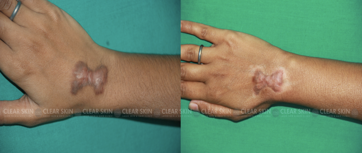 Keloid Removal Surgery Before And After