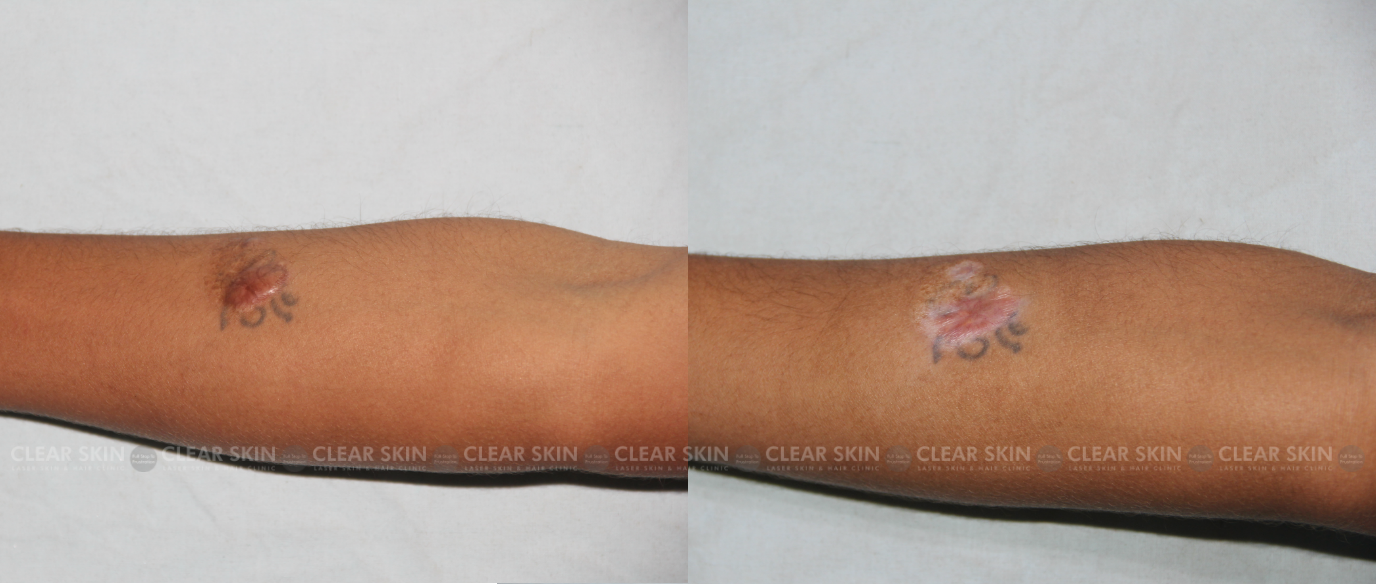 Hand Keloid Before And After