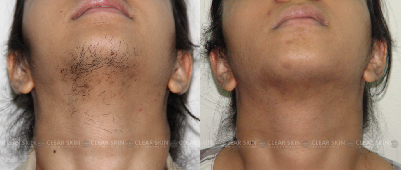 Diode Laser Hair Removal - Benefits and Treatment Cost | Clear Skin, Pune