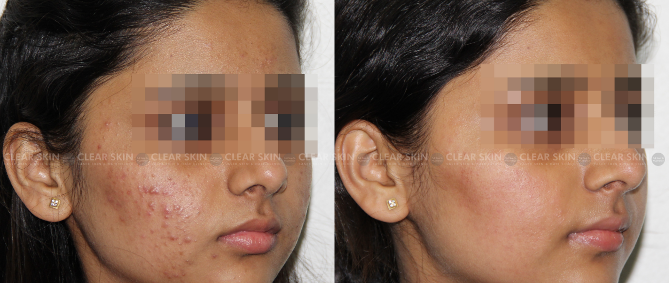Low Level Laser Light Treatment (LLLT): Procedure and Benefits| Clear Skin,  Pune