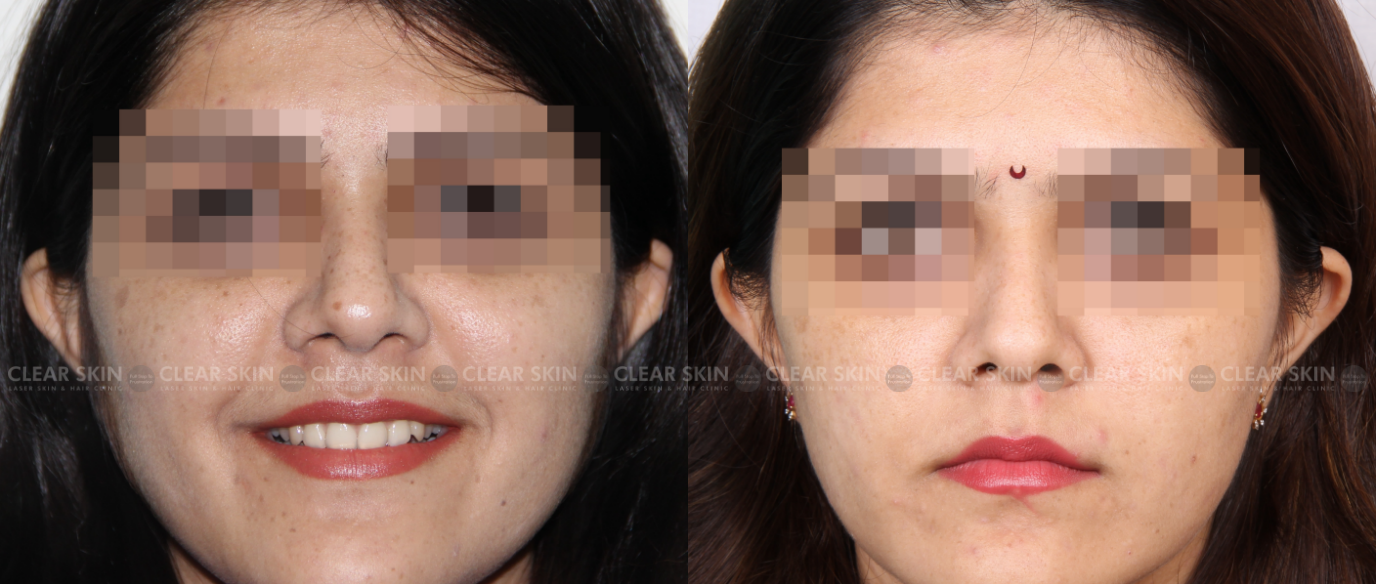 Skin Rejuvenation Treatment Before And After