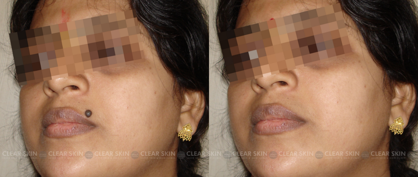Facial Mole Removal Before And After