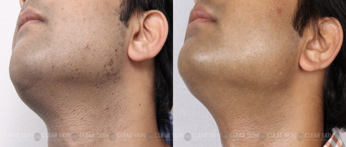 Skin Growth Before After