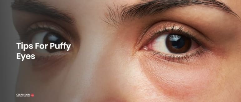Bonus vooroordeel collegegeld 20 powerful tips and home remedies to get rid of puffy eyes