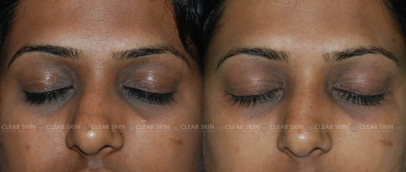 PRP Treatment For Dark Circles Before And After