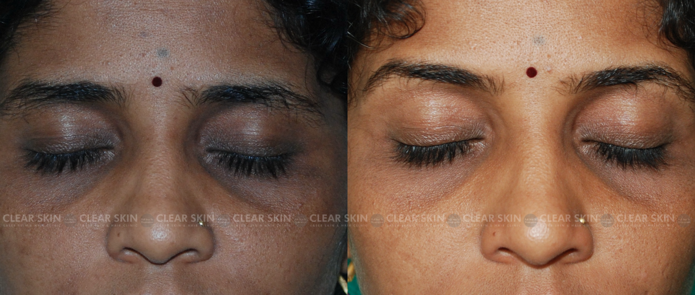 Botox For Dark Circles Before And After