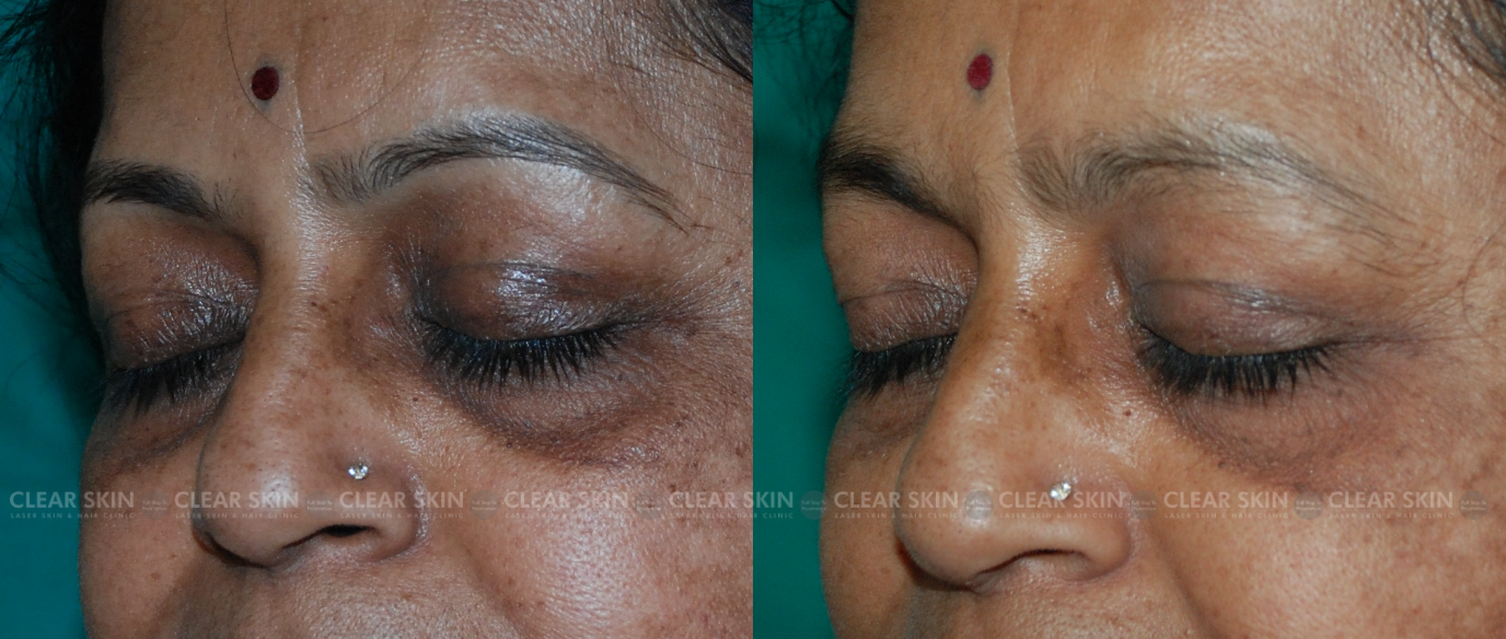genert Uafhængig Traktat Under Eye Dark Circles Treatment at Clear Skin Clinics Pune