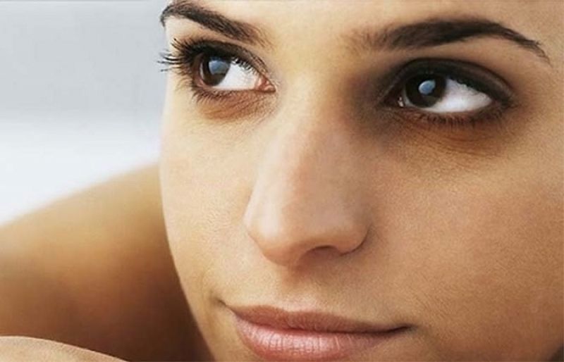 What Is Dark Circles Under The Eyes?