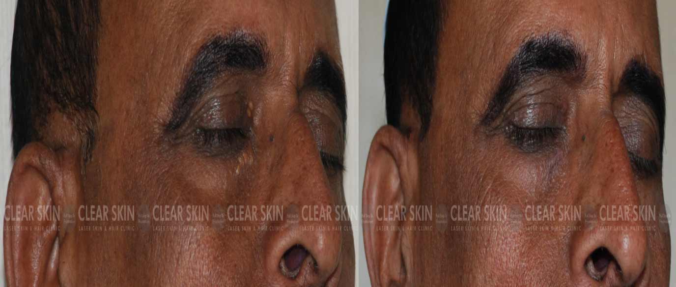 Xanthelasma Before And After Results