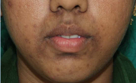 How do you treat hyperpigmentation on lips | ClearSkin, PuneHow to get rid  of pigmentation around lips? - skincare