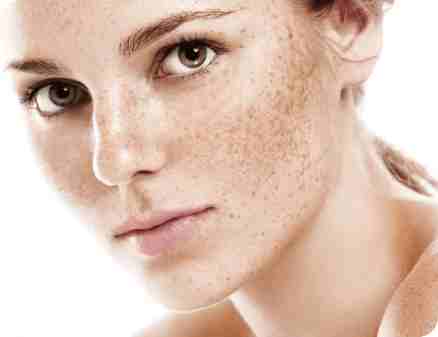 Co2 Laser For Freckles