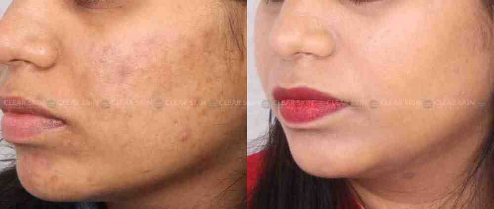 Acne Grade 1 Treatment Results Before And After