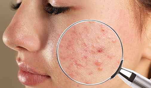 Acne Pimples