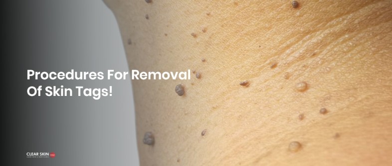 Skin Tags and Sebaceous Cyst Removal