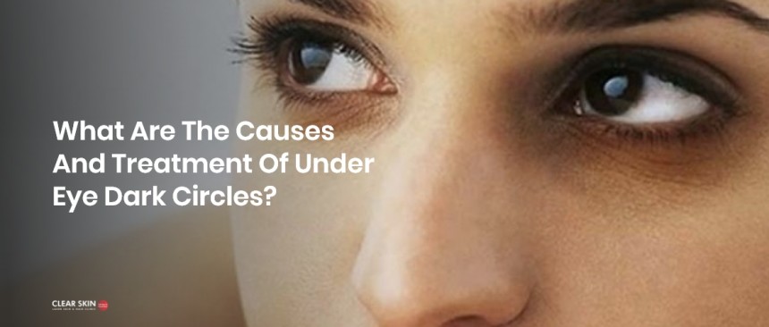 Dark Circles Under Eyes Causes And Treatment Clearskin