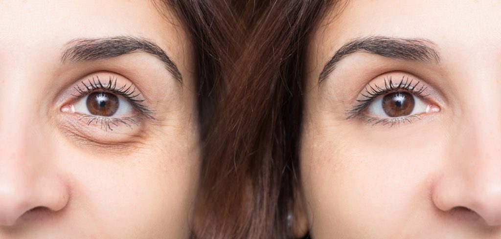 Under Eye Bags | New York Eyelid Blepharoplasty Expert Dr. Jessica Lattman