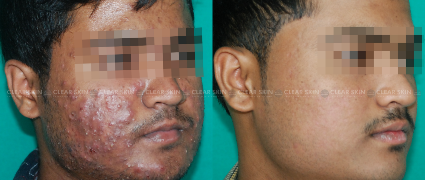 Acne Grade 4 Before And After