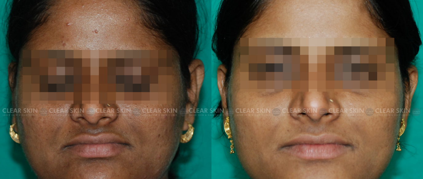 Skin Rejuvenation Before And After Photos